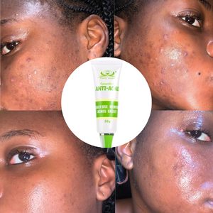 Crème Anti-Acné à l’Aloe Vera